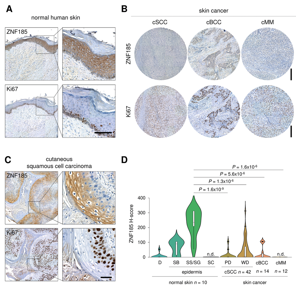 ZNF185 is down-regulated in skin cancer. (A) Immunohistochemical analysis of ZNF185 expression in normal skin. Ki67 was used as a marker of proliferation. Scale bar: 100 µm. (B) Immunohistochemical analysis of ZNF185 expression in skin cancer: cutaneous basal cell (cBCC), squamous cell carcinoma (cSCC), and malignant melanoma (cMM). Ki67 was used as a marker of proliferation. Scale bar: 250 µm. (C) Immunohistochemical analysis of ZNF185 expression in cutaneous squamous cell carcinoma (well differentiated). Ki67 was used as a marker of proliferation. Scale bar: 50 µm. (D) Violin plot showing H-score of protein expression level of ZNF185 in the normal skin (D – dermis, SB – basal layer, SS/SG – spinous and granular layers, SC – cornified layer) and skin cancer (cSCC (cSCC subpopulations: PD – poorly-differentiated cells, WD – well-differentiated cells), cBCC, and cMM).