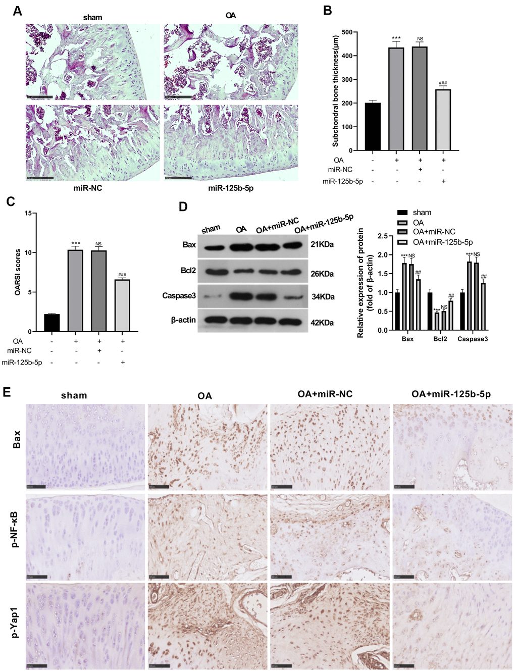 Overexpressing miR-125b-5p alleviated OA development in rats. The OA rat model was constructed by destabilization of the medial meniscus (DMM). The knee tissues of OA rats were transfected with miR-NC as the control and further transfected with miR-125b-5p mimics. (A) Safranin O staining and toluidine blue staining were carried out to observe morphological differences of the rat knee sections. (B) The thickness (μM) of the subchondral bone plate. (C) OARSI score. (D) WB detected the expression of apoptotic proteins Bax, Bcl2 and Caspase3 in the knee tissues. (E) The expression of Bax, p-YAP1 and p-NF-κB was compared by IHC. ***PP>0.05 (vs. OA group), ##P