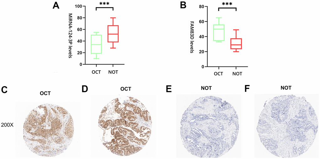 The expression level of hsa-miR-142-3p and FAM83D in normal ovarian tissues (NOTs) and OC tissues (OCTs). (A). Validation of hsa-miR-142-3p ((***, p B). Validation of FAM83D (***, p C, D). The expression level of FAM83D in human OCTs. (E, F). The expression level of FAM83D in human NOTs (scale bar: 200×).