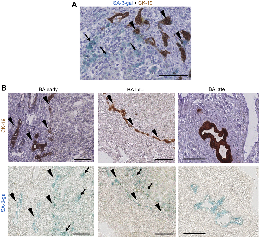 Cholangiocytes and perinodular hepatocytes display cellular senescence in BA livers. (A) Co-staining of SA-β-gal activity and CK-19 IHC on BA livers: some bile ductules cholangiocytes show staining co-localization (arrowheads) while perinodular hepatocytes are only positive for SA-β-gal (arrows); (B) Serial staining of SA-β-gal activity and CK-19 IHC on BA livers cryosections. Left and middle images: bile ductules (arrowheads) and perinodular hepatocytes (arrows) are positive for SA-β-gal in both early and late stage BA. Right images: remaining large septal bile duct display SA-β-gal activity. BA: biliary atresia; IHC: immunohistochemistry; SA-β-gal: senescence-associated beta-galactosidase. Scale bars = 100 μm.