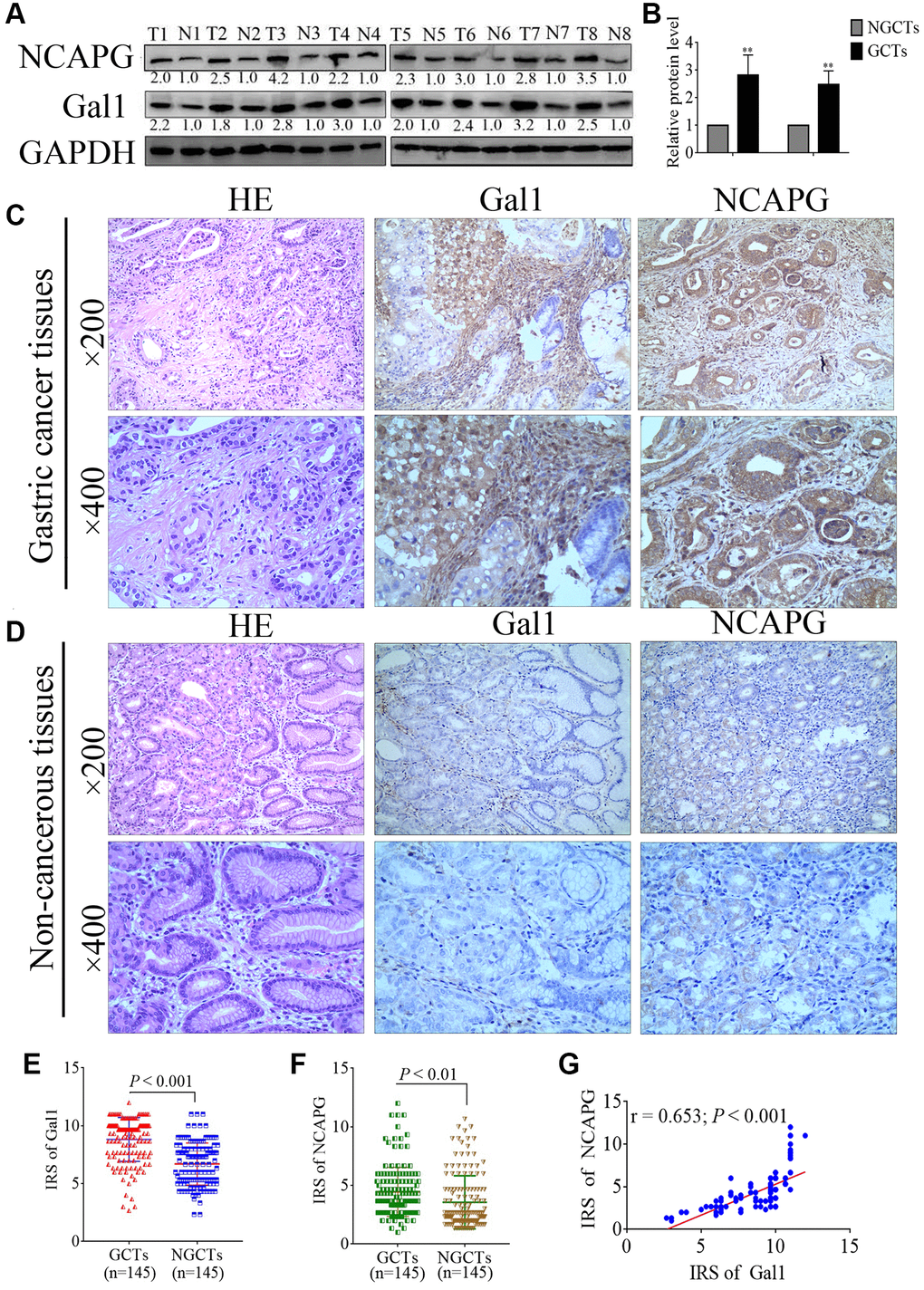 Gal1 and NCAPG expression predict prognosis of gastric cancer (GC). (A, B) Expression of Gal1 and NCAPG proteins detected by Western blotting in GC cancer tissues (GCTs) and non-gastric cancer tissues (NGCTs). (C, D) Representative immunohistochemistry images for Gal1 and NCAPG in (C) GC tissues, and (D) matched non-cancerous tissues. (E) Immunoreactivity score (IRS) for Gal1 compared between GCTs and matched NGCTs. (F) IRS for NCAPG compared between GCTs and matched NGCTs. (G) The expression of Gal1 was positively correlated with NCAPG expression in GC tissues. Abbreviations: T: tumor tissue; N: non-tumor tissue; GCTs: gastric cancer tissues; NGCTs: non- gastric cancer tissues. **P 