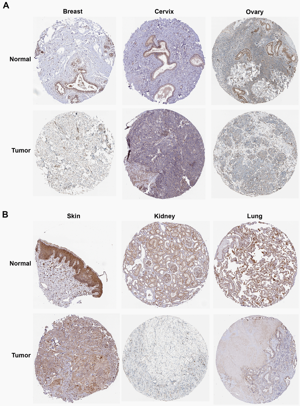 The protein expression of ROCK1 in pan-cancer. (A) The protein expression level of ROCK1 in women-specific cancers (Breast tumors, Cervical tumors, and Ovarian tumors versus normal tissues. (B) The protein expression level of ROCK1 in Skin tumors, Renal tumors, and Lung tumors versus normal tissues.