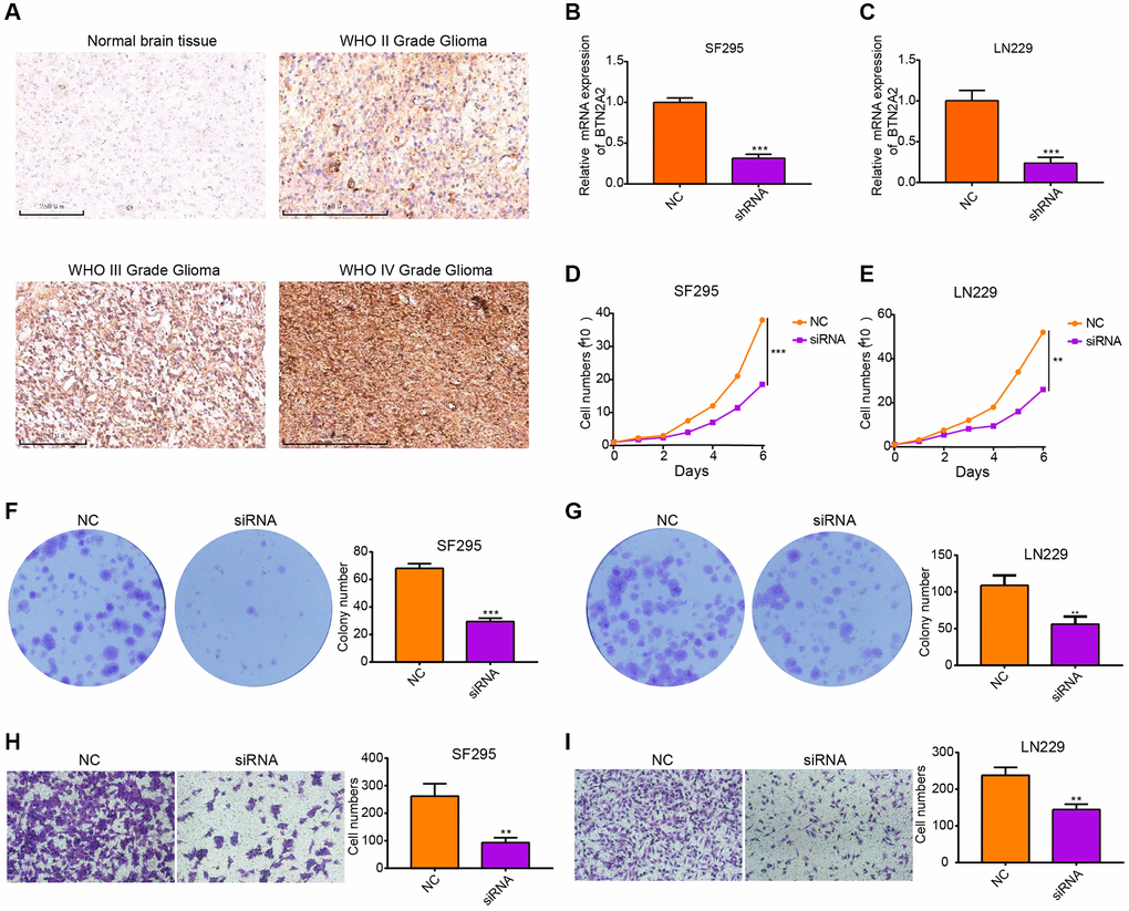 Knockdown of BTN2A2 expression inhibits the proliferation and migration of glioma cells. (A) IHC shows BTN2A2 expression in glioma and normal brain tissues. (B, C) The efficacy of BTN2A2 knockdown in SF295 and LN229 using qRT-PCR. (D, E) BTN2A2 knockdown inhibits the growth of SF295 and LN229 cells determined using growth curve. (F, G) BTN2A2 knockdown inhibits the migration of SF295 and LN229 cells determined using the colony information assay. (H, I) BTN2A2 knockdown inhibits the migration of SF295 and LN229 cells determined using the transwell assay. Scale bar = 250 um. Abbreviations: NC: Negative control; siRNA: Knockdown of BTN2A2. *P **P ***P 
