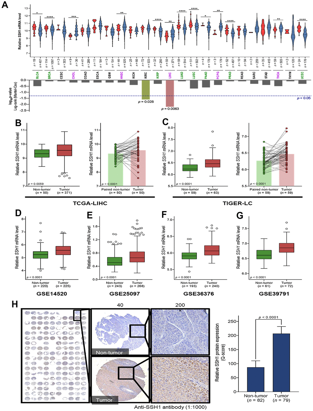 SSH1 is aberrantly expressed in hepatocellular carcinoma (HCC). (A) Violin plots with the graphical representation of the associated Mantel-Cox test showing the differential expression of SSH1 mRNA in 23 cancer types from the TCGA database. (B) Box plots of the relative SSH1 mRNA expression levels in the general non-tumor and tumor cases (left) or in paired non-tumor-tumor cases (right) of the TCGA-LIHC cohort. (C) Box plots of the relative SSH1 mRNA expression levels in the general non-tumor and tumor cases (left) or in paired non-tumor-tumor cases (right) of the TIGER-LC cohort. Box plots showing the relative SSH1 mRNA expression levels in non-tumor and tumor cases from the (D) GSE14520, (E) GSE25097, (F) GSE36376, and (G) GSE39791 HCC cohorts. (H) Representative IHC staining of HCC tissue microarray and histogram showing the protein expression of SHH1 in tumor and non-tumor based on the Q-score. *p p p 