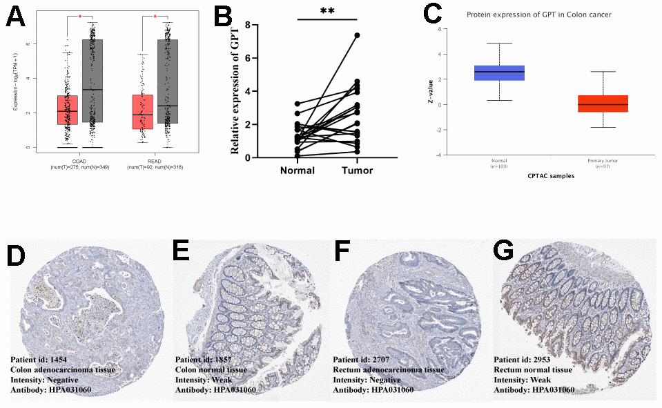 External data and experimental data verify GPT expression of GPT in CRC. (A) GEPIA2 database showing differential expression of GPT in COAD and READ (mRNA level). (B) qRT-PCR showed that GPT was significantly lower in CRC tissues than in adjacent normal tissues. (C) The UALCAN database showed that the low expression of GPT in COAD was correlated with cancer tissues (protein level). (D, E) HPA database showing IHC images of GPT in COAD and colon normal tissues. (F, G) HPA database showing IHC images of GPT in READ and rectal normal tissues.