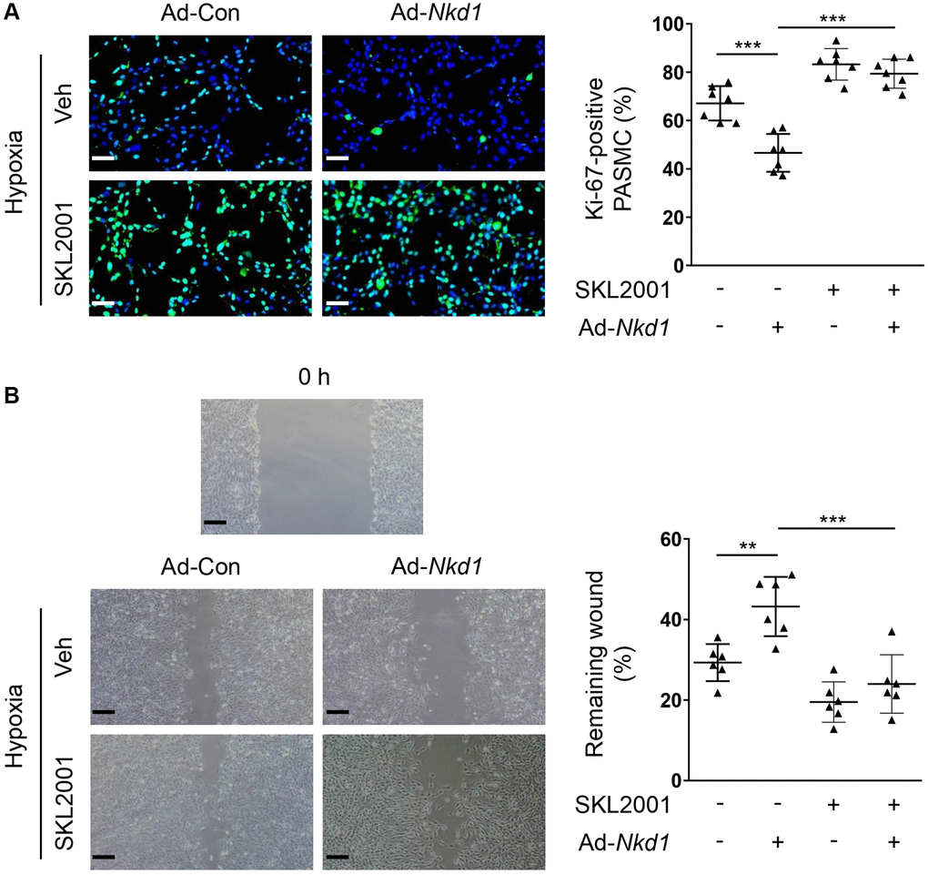 NKD1 inhibits hypoxia-induced proliferation and migration of PASMCs via reducing β-catenin expression. Hypoxia-challenged PASMCs were transfected with Ad-Con or Ad-Nkd1 and then cultured with or without SKL2001 treatment. (A) Above treated PASMCs were stained with Ki-67 (green) and DAPI (blue). Representative pictures and the corresponding percentage of Ki-67-positive PASMCs were shown (post hoc for LSD test; n = 7 samples). Bar = 50 μm. (B) Migration of above-treated PASMCs were assessed by wound-healing assay (post hoc for LSD test; n = 6 samples). Bar = 200 μm. Data were shown as mean ± S.D. **P ***P 