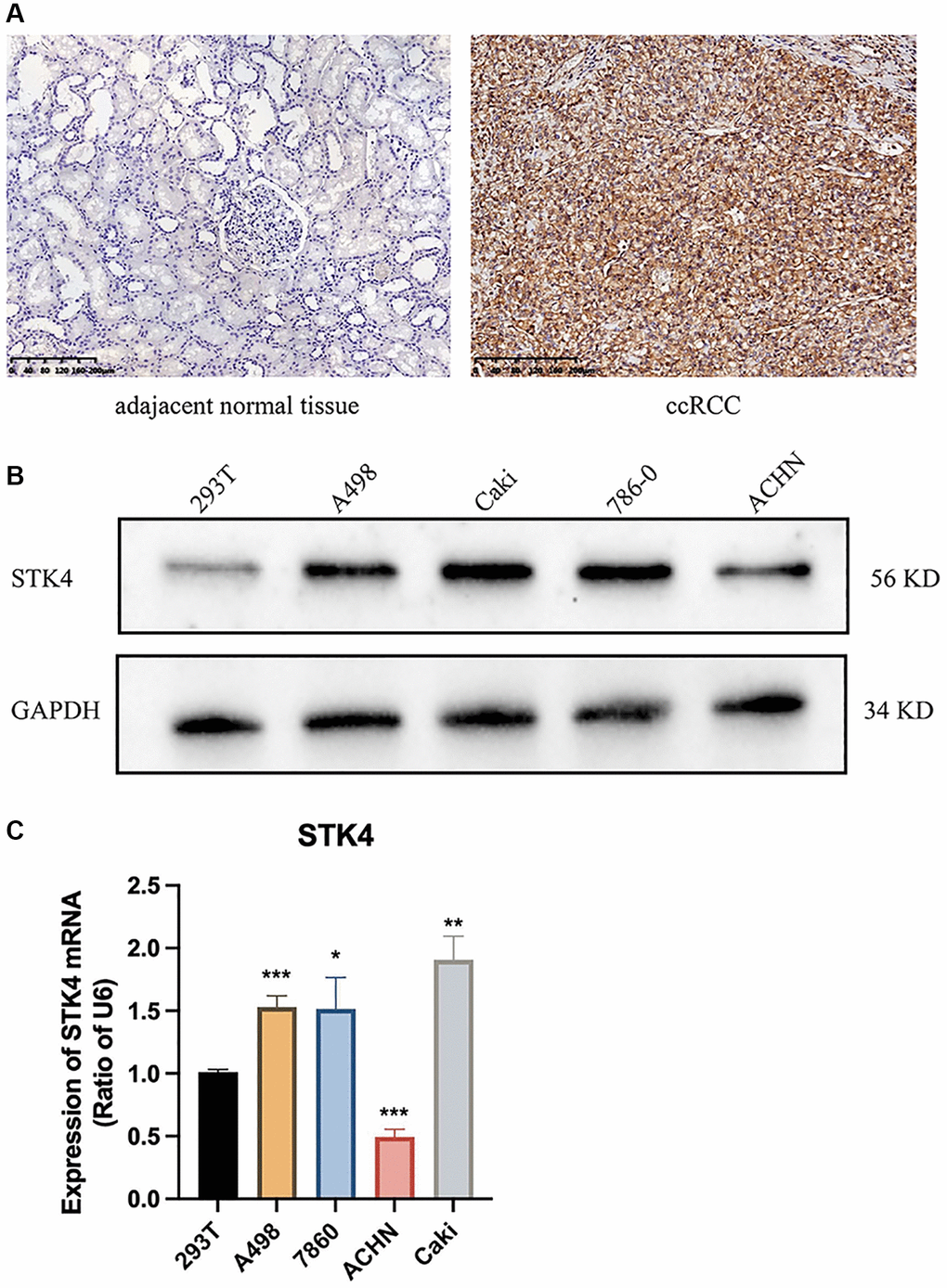 Experiment results of STK4 expression in ccRCC. IHC (A), WB (B), and q-pCR (C) results of STK4 expression in ccRCC.