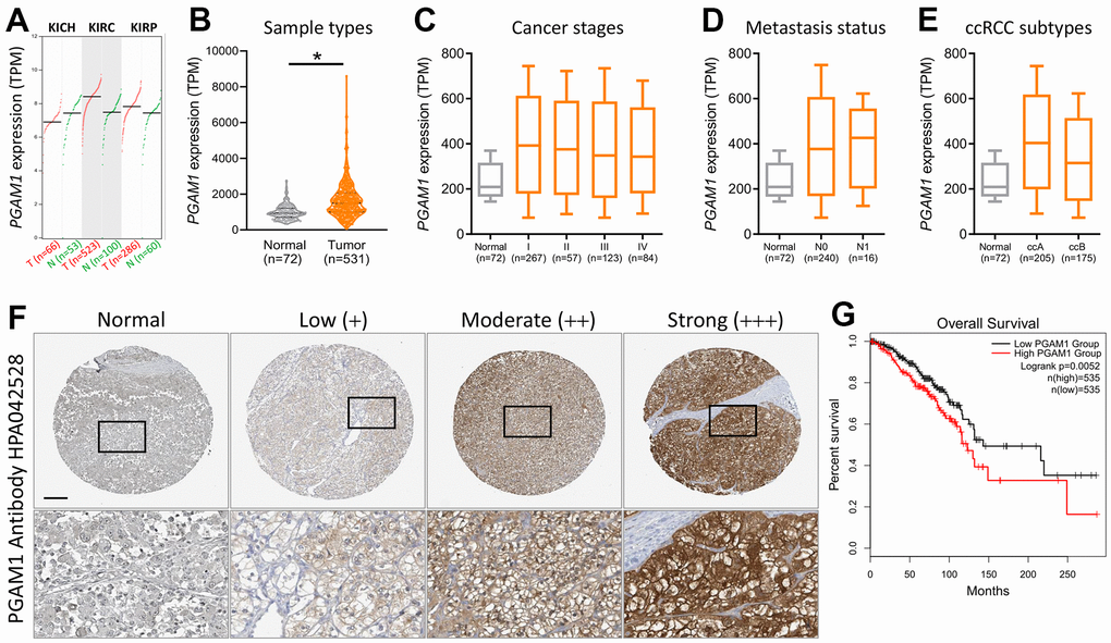Evaluation of the diagnostic potential of PGAM1 expression in KIRC biopsy specimens. (A) PGAM1 gene expression levels in renal cancer. (B) Comparison of PGAM1 expression between KIRC tumor and non-tumor tissues. Boxplots depicting PGAM1 expression levels across different stages (C), metastasis status (D), and ccRCC subtypes (E) of KIRC. (F) Comparative immunohistochemical analysis of PGAM1 expression in KIRC tissue samples from four different patients based on the Human Protein Atlas. (G) Prognostic significance of PGAM1 mRNA levels for overall survival, as determined using the Kaplan-Meier plotter dataset.