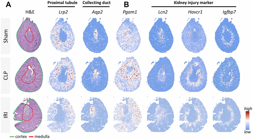 Resolving spatial relationships of cell type and gene expression using spatial transcriptomics in a mouse kidney injury model. (A) H&E-stained sections of 3 mouse models: sham operation, ischemia/reperfusion injury (IRI), and cecal ligation and puncture (CLP), respectively. Different regions of the cortex (Lrp2) and medulla (Aqp2) were labeled using tissue-specific biomarkers. (B) Analysis of Pgam1 and different biomarkers of renal injury (Lcn2, Kim1, Havcr1).