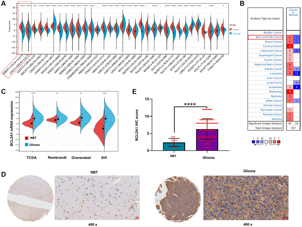 BCL2A1 was overexpressed in gliomas. (A) The expression of BCL2A1 in 33 human cancers and normal tissues in TCGA and GTEx databases. (B) The expression of BCL2A1 in different types of cancers in Oncomine. (C) The mRNA expression of BCL2A1 in gliomas and NBTs in public datasets. (D, E) IHC staining analysis of BCL2A1 in glioma NBTs in an in-house cohort. *P **P ***P ****P 
