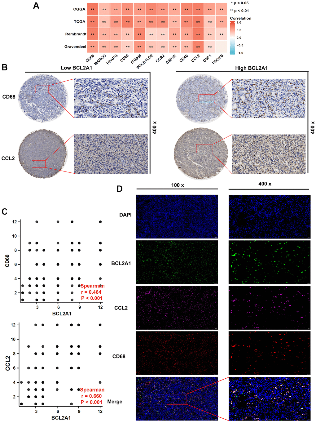 BCL2A1 was associated with tumor-associated macrophage infiltration in gliomas. (A) The correlation between BCL2A1 and tumor-associated macrophage markers in TCGA, CGGA, Rembrandt and Gravendeel datasets. (B) IHC staining analysis of CD68 and CCL2 in glioma tissues. (C) Spearman correlation was used to explore the correlation between TAM infiltration and BCL2A1 expression. (D) The relationship between BCL2A1, CD68 and CCL2 was analyzed by multiple immunofluorescences. Abbreviation: TAMs: tumor-associated macrophages.