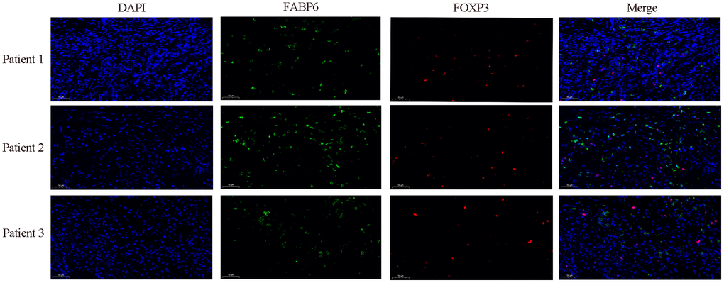 Immunofluorescence staining further verified the relationship between FABP6 expression and Treg infiltration. Immunofluorescence staining was performed on esophageal cancer specimens to examine FABP6 expression and Treg infiltration. The Treg lineage-specifying transcription factor FOXP3 served as a Treg marker. FABP6 (green), FOXP3 (red) and DAPI (blue) staining. Scale bar, 50 μm.