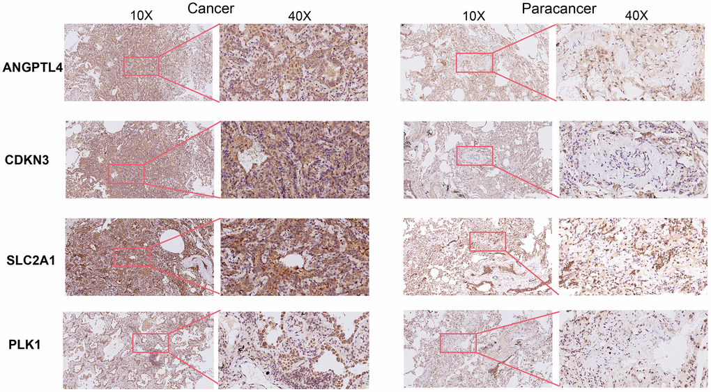 Immunohistochemical staining of four ARGs in cancer tissues and para-cancer tissues from clinical LUAD patients.