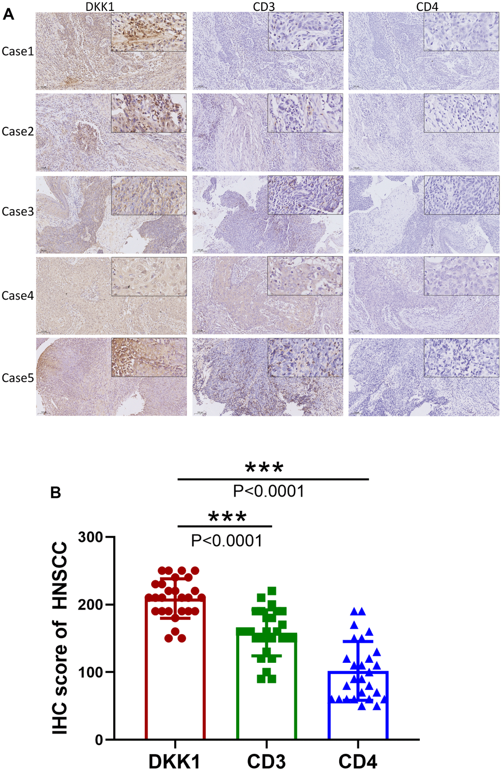 Increased DKK1 expression and decreased CD3 and CD4 expression in HNSCC. (A) IHC of DKK1, CD3, and CD4 expression in representative HNSCC samples. (B) Scatter plots showing that the DKK1, CD3, and CD4 IHC scores differed significantly in HNSCC (***p 