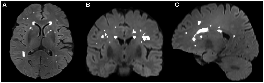 Segmentation of WMH volumes in the transverse (A), coronal (B), and sagittal (C) positions on FLAIR images. The white color represents the automatically segmented WMH range. WMH, white matter hyperintensities.