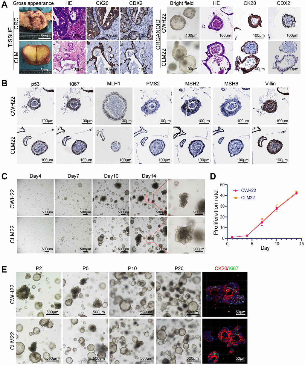 CWH22 and CLM22 organoids maintain histological and proliferative characteristics of the corresponding tumors. (A) H&E staining of the tumor organoids showing the resemblance of the organoids to the lumens and tubular structures of the primary tumor. IHC staining demonstrated consistent positive expression of CK20 and CDX2 in the organoids and corresponding tumors (scale bars, 100 μm). (B) IHC staining of CWH22 and CLM22 organoids demonstrating the consistent expression of p53, Ki67, MLH1, PMS2, MSH2, MSH6, and Villin, with the expression in CRC and CLM tissues (Supplementary Figure 1C). Scale bars, 100 μm. (C) Representative time course of CWH22 and CLM22 organoid growth for 14 days (scale bars, 500 μm) and local field amplification (scale bars, 200 μm). (D) Analysis of the proliferation rates of CWH22 and CLM22 organoids over time using 3D cell viability tests. (E) Bright-field images showing the morphology of CWH22 and CLM22 organoids at the 2nd, 5th, 10th, and 20th passages (P2, P5, P10, and P20, respectively; scale bars, 500 μm), and the expression of CK20 and Ki67 in representative differentiated organoids from CWH22 and CLM22 (scale bars, 50 μm).