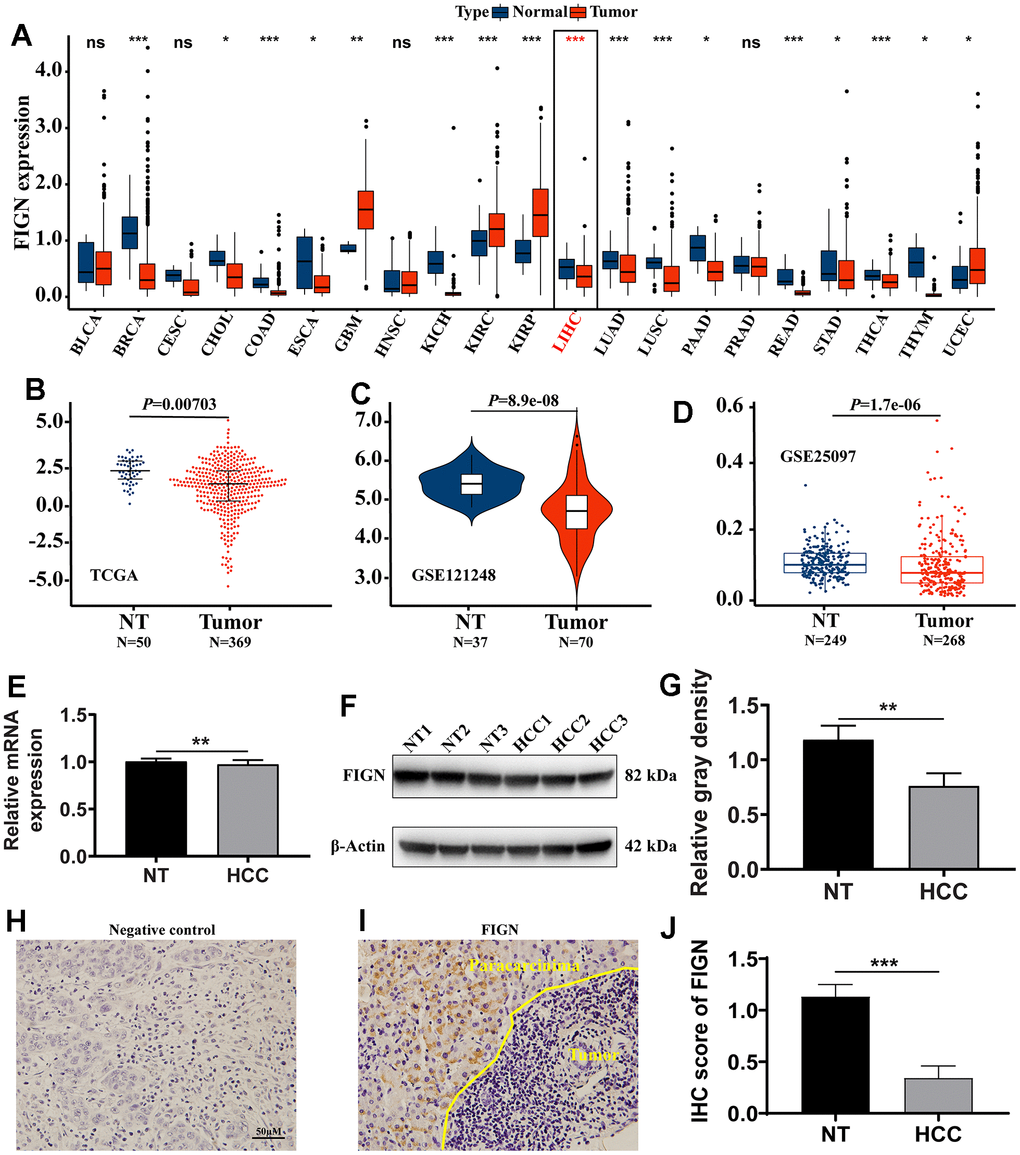 The expression of FIGN in hepatocellular carcinoma and pan-carcinoma. (A) The mRNA expression of FIGN was downregulated in 14 of 21 cancer types compared with normal tissues. Difference in expression of FIGN between HCC and normal tissues in TCGA data sets (B), GSE121248 (C) and GSE25097 (D). (E) Relative mRNA expression in HCC and paracarcinoma tissues. N=30. (F) Protein levels of FIGN in HCC and adjacent normal tissues. (G) Relative gray density analysis on bands of Figure F. (H–I) Immunohistochemistry assay to detect the expression of FIGN in HCC and paracarcinoma tissues. (H) was negative control. N=3, scale bar=100μM. (J) Difference in FIGN IHC score in HCC and matched paracarcinoma tissue. The two groups were compared using t-tests. *P P P 