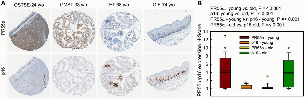 PR55α level is much lower in human normal tissue specimens of older individuals compared to younger individuals and inversely correlates with p16 levels. Human normal tissue specimens derived from various organs/sites were analyzed for differences in PR55α and p16 expression by IHC. (A) Representative images of adjacent tissue sections stained with anti-PR55α and anti-p16 antibodies. OSTSE–tonsil; GMST-seminiferous tubules; ET-thyroid; GIE-esophagus. Young, ≤43 y/o; Old, ≥68 y/o; (B) Box plot shows the H-Score quantification of PR55α and p16 expression from adjacent sections.