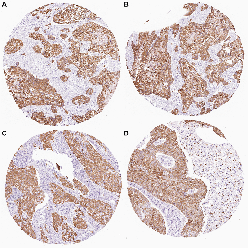 KRT6A expression in NSCLC tissues. (A–D) KRT6A is highly expressed in lung cancer tissues.
