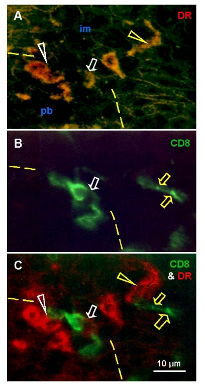  Uterine cervix dual color immunohistochemistry (HLA-DR peroxidase/CD8 FITC) viewed in dark field visible light (A), incident fluorescence (B) and dark field fluorescence (C). (A) Interface (dashed line) between parabasal and intermediate layers. White arrowhead shows differentiating DC, yellow arrowhead shows mature DC. Arrow indicates activated T cell with HLA-DR expression (see below). (B) White arrow indicates T cell exhibiting unusual elongated shape at the interface. Yellow arrows indicate residual CD8 expression in fragmented T cell among adjacent im epithelial cells. (C) Activated T cell with HLA-DR expression (white arrow) interacts with differentiating DC (white arrowhead). Mature DC (yellow arrowhead) accompany T cell fragmentation (yellow arrows). Reprinted from Ref. [4], © Antonin Bukovsky. 