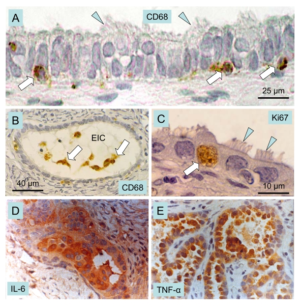 Macrophages, cytokines and ovarian cancer