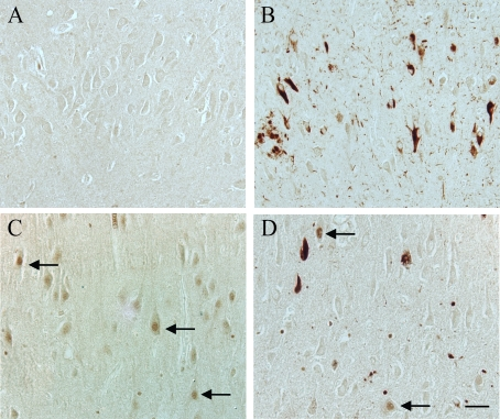  In an 87 year old AD case, hippocampal tissue sections demonstrate significant localization of pMcm2 protein in NFT, dystrophic neurites, and neuropil threads (B). In another AD case, in the CA3 region, in addition to pathological structures, a few pyramidal neuron nuclei (arrows) have significant pMcm2 accumulation (D). Most control cases, representative case age 61 years, demonstrate no neuronal staining for pMcm2 protein (A), while a few older control cases demonstrate significant nuclear immunolocalization in the pyramidal neurons (control case age 74 years, C) Scale bar= 50 μm. 
