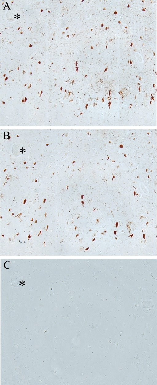  Adsorption of pMcm2 antibody confirms specificity to corresponding pMcm2 antigen. (A) AD hippocampal tissue stained with pMcm2 antibody. (B) Adjacent section treated with pMcm2 antibody absorbed with non-phosphorylated Mcm peptide demonstrates similar staining. (C) Adjacent section treated with pMcm2 antibody absorbed with phosphorylated Mcm2 peptide demonstrates complete absorption. * denotes landmark vessel. 