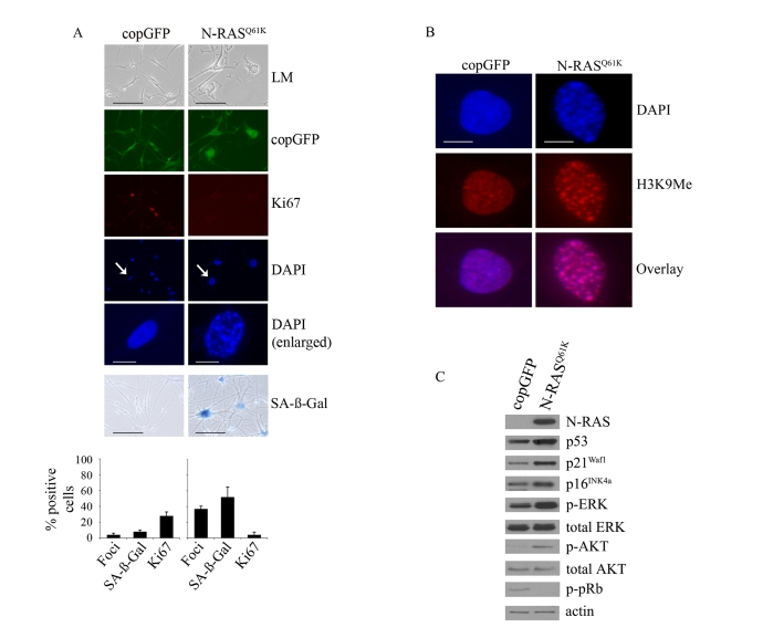 Oncogenic N-RASQ61K induces proliferative arrest and senescence of human melanocytes. (A) Human melanocytes were transduced with lentiviruses expressing N-RASQ61K or copGFP control. The efficiency of transduction was controlled with the co-expression of copGFP and was consistently above 90%. Cell proliferation (Ki67), chromatin condensation (DAPI), and the appearance of increased SA-β-Gal activity were analyzed and quantitated 15 days after infection. Percentage of cells positive for the indicated marker is shown in histograms, which correspond to the mean ± s.d. of at least two independent transduction experiments from a total of at least 300 cells. Cells enlarged to show DAPI-stained chromatin foci are indicated with arrows (bar =10 μm). LM, light microscopy (bar=100μm). (B) Human epidermal melanocytes infected with lentiviruses expressing N-RASQ61K or copGFP were stained with DAPI and antibodies to H3K9Me, 15 days post transduction (bar =10 μm). (C) Expression of the indicated proteins was determined by western blot analysis 15 days after infection of human epidermal melanocytes with lentiviruses expressing N-RASQ61K or copGFP control. 