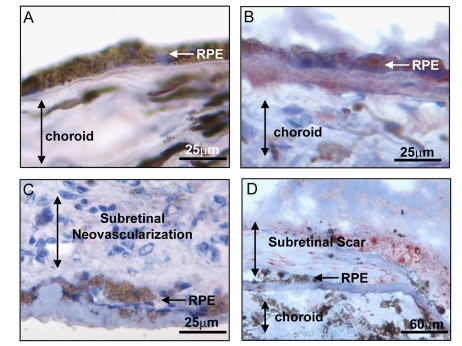  Expression of BMP4 in late stages of age related macular degeneration (AMD). Immunohistochemical stains for BMP4 (red chromogen) in retinal pigment epithelium (RPE)/choroid tissue sections from donor eyes with hematoxylin counterstain. In (A) a control individual without AMD shows no apparent BMP4 staining in RPE or choroid. In (B) an individual with late dry AMD, away from a region of geographic atrophy shows prominent BMP4 immunoreactivity in RPE and in the accumulated drusen material between the RPE and the choroid. In (C) an individual with neovascular form of late AMD shows no apparent BMP4 staining in the RPE or the neovascular lesion between the RPE and retina. In (D) an individual with neovascular form of late AMD that further progressed to scar with loss of neovascular channels shows re-expression of BMP4 staining in cells within and adjacent to the lesion. Note loss of most cells in RPE layer. The institutional review board (IRB) of the University of Southern California approved our use of human donor eyes. All procedures conformed to the Declaration of Helsinki forresearch involving human subjects. 