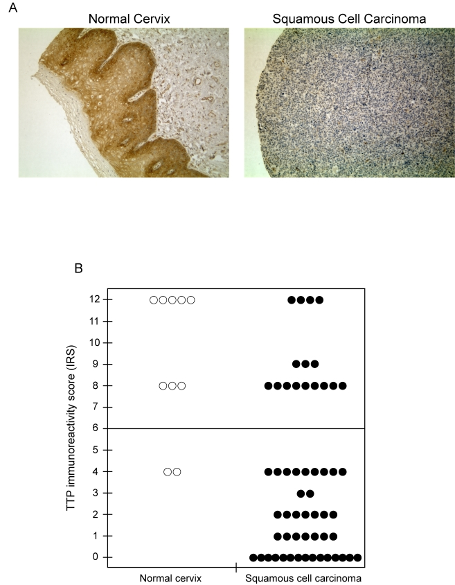 TTP protein expression is lost in human cervical cancer