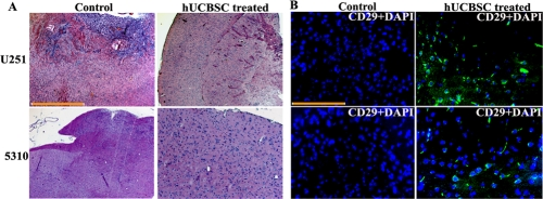 Intracranial regression of tumor growth by hUCBSC
