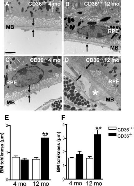 CD36 deficiency leads to BM thickening