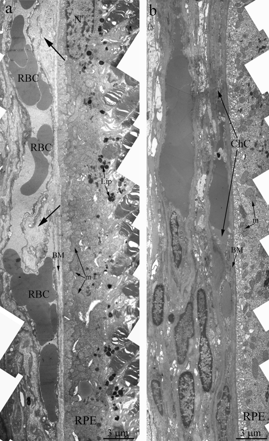 Outer retina of Wistar (a) and OXYS (b) rats at the age of 12 months. Arrows show thickening of Brunch membrane. RPE – retinal pigment epithelial cell, N – RPE nucleus, m – mitochondrion, BM – Bruch's membrane, ChC – choriocapillaris complex, RBC – red blood cell.