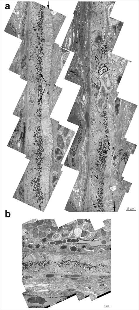 (a) Ultrastructure of pigment epithelium of 25-months-old OXYS rat. Selected area is shown under high magnification. Lip – lipofuscin material, N – retinal pigment epithelial cell nucleus. (b) Region of pigment epithelium of 25-months-old OXYS rat. Retina injure was estimated as 3 units. INL – inner nuclear layer, where the body and nucleus of interneurones is lied; OPL – outer plexiform layer – where axon of photoreceptor and dendrite of interneurone are in contact; ONL – outer nuclear layer, body and nucleus of photoreceptors; PRL – photoreceptors, RPE – retinal pigment epithelial cell. Arrow shown the blood vessel.