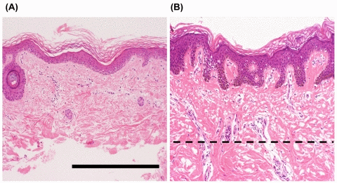 Representative histological features of the skin from patients with Werner syndrome (WS)