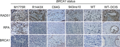 RAD51 and RPA levels are elevated in human breast cancer tissue with a BRCA1 M1775R mutation