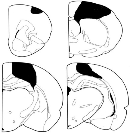 Coronal sections representing the extent of a typical stroke