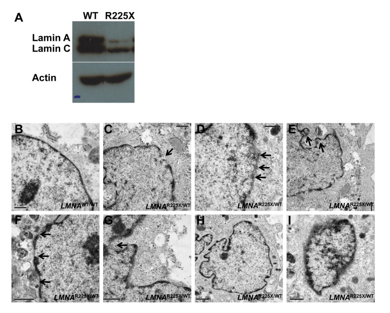 LMNAR225X/WT dermal fibroblasts showing nuclear defects and accelerated apoptosis upon electrical stimulation