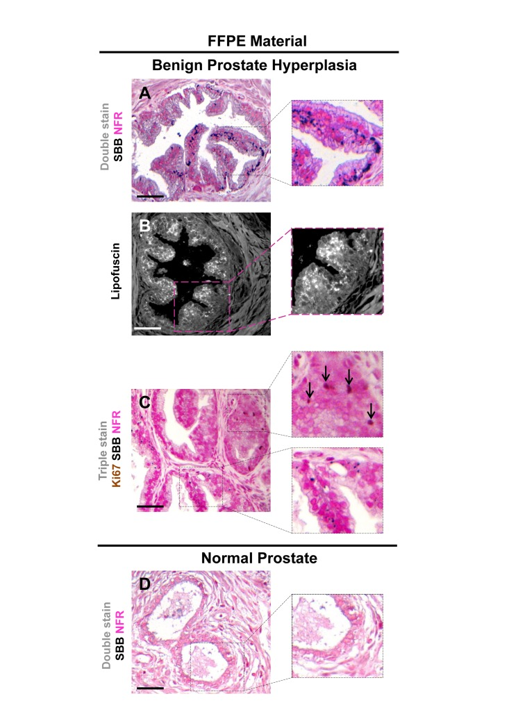 Accumulation of lipofuscin in formalin-fixed paraffin-embedded (FFPE) tissues from benign prostatic hyperplasia (BPH) that corresponds to senescent areas as depicted by Senescence-Associated beta-galactosidase (SA-β-gal) in cryo-preserved material