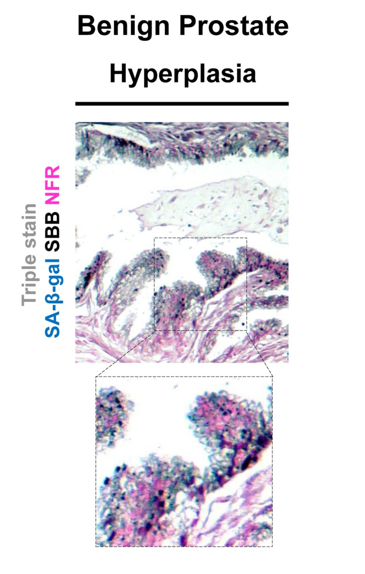 Co-localization of Senescence-Associated beta-galactosidase (SA-β-gal) activity and lipofuscin depiction in fresh-frozen tissue sample of benign prostatic hyperplasia (BPH) pretreated with SA-β-gal and subsequently embedded in paraffin