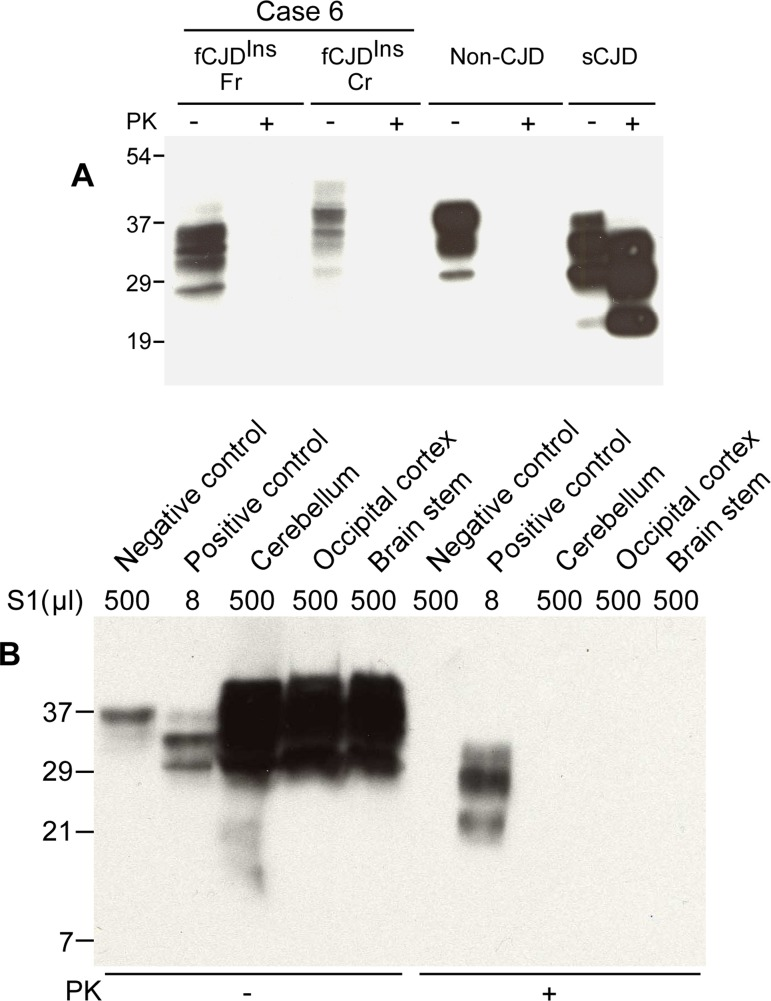 Detection of PK-sensitive PrPSc. (A) Conventional Western blotting of PrP treated with or without PK in case 6. Fr: frontal cortex; Cr: cerebellum. No PrP was observed after PK treatment in the samples from both fCJDIns (case 6) and non-CJD. The PK-resistant PrP27-30 was indicated in the sample from sCJD. The migration of PrP from the cerebellum of case 6 was slightly slower than that of PrP from both non-CJD and sCJD controls. (B) Precipitation of abnormal PrP by NaPTA. S1 from non-CJD (500 μl), sCJD (8 μl), and case 6 (three brain regions: 500 μl each) was incubated with NaPTA and then was subjected to SDS-PAGE and immunoblotting with 3F4. Although a small amount of PrP was precipitated from non-CJD brain sample (500 μl of S1), no PK-resistant PrP fragments were detected. NaPTA was able to precipitate PrP from 8 μl of sCJD S1 (62.5-fold less than non-CJD S1) and the precipitated PrP was resistant to PK-digestion. Compared to non-CJD sample, NaPTA precipitated large amounts of PrP from three different brain regions of case 6 including the cerebellum (Cr), occipital cortex (Oc) and brain stem (BS). After PK-treatment of the NaPTA-precipitated PrP from case 6, no PrP bands were observed.