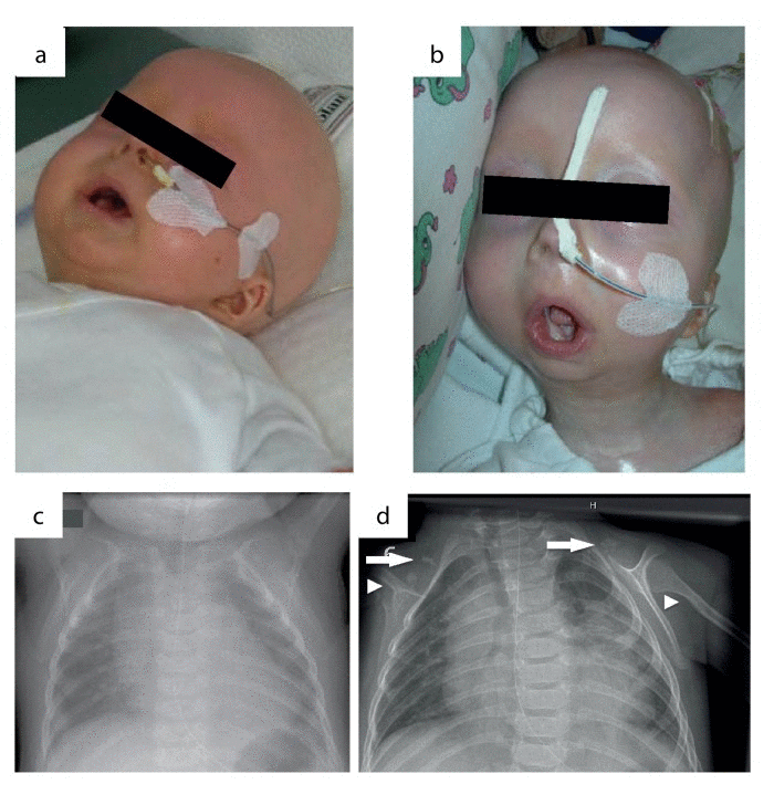 Phenotypic changes in the course of disease progression at age of 4 months (a) and age of 11 months (b). Chest x-rays were performed at age of 4 (c) and 11 months (d). Normal skeletal findings at age of 4 months are displayed. Missing of both claviculae at age of 11 months, residual bone fragments are denoted by arrows. Deformation and narrowing of both humeri at age of 11 months are marked by arrowheads.