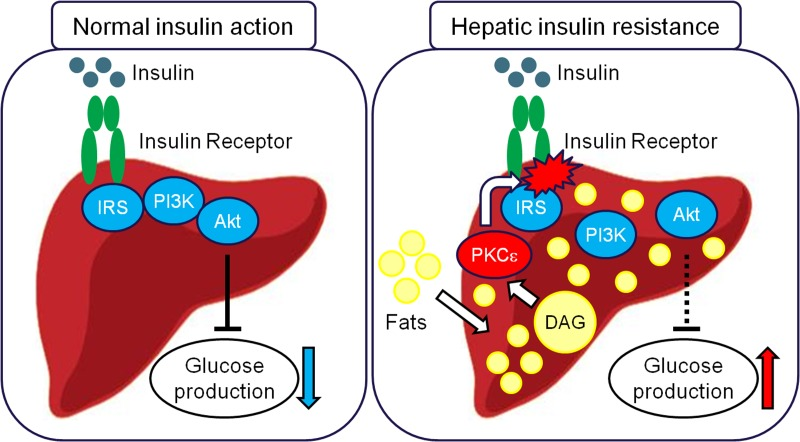 In normal insulin action (left panel), insulin binds and activates the insulin receptor kinase leading to phosphorylation of IRS proteins, recruitment and activation of PI3K, activation of Akt and ultimately suppression of glucose production and stimulation of glucose uptake and storage as glycogen. Recent studies, have indicated that in hepatic insulin resistance this signaling mechanism is defective (right panel). Hepatic accumulation of diacylglycerols (DAGs) due to: 1) increased delivery of fatty acids to the liver, 2) increased de novo lipogenesis and/or 3) decreased hepatic fat oxidation triggers PKCε activation which in turn inhibits insulin receptor kinase activity leading to disruption of downstream insulin signaling, thus resulting in an inadequate ability of insulin to suppress hepatic glucose production and glucose uptake and storage as glycogen.