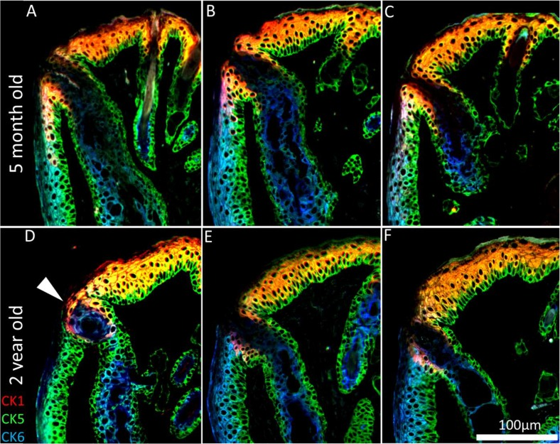 Keratinization of the meibomian gland orifice. (A-C) A 5month and (D-F) 2year old mouse lid margin cross-sections. (D) Gland plugging and (D-F) a loss of CK1+ cells posterior to the orifice causes the mucocutaneous junction to shift anteriorly in the aged mouse eyelid. CK1 immunostaining shows no hyper-keratinization or obstruction in the atrophic meibomian glands.