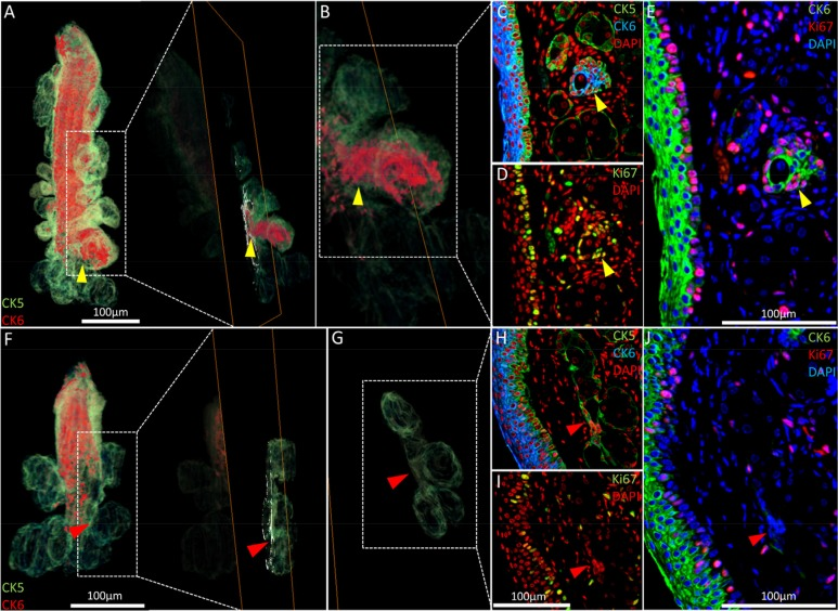 Nascent acini and their absence with aging. (A) A 3-D reconstruction of the 5 month old meibomian gland and an orthoslice taken at the region of interest: the transition between duct and acini (yellow arrowhead). (B) An acinus with a significant CK6+ component (C) also exhibits localized proliferation in the same region, according to Ki67 staining (D) and the resulting overlay (E). (F) The 3-D reconstruction of a 2 year meibomian gland with ductal truncation was evaluated at the same transitional region between duct and multiple acini (G - red arrowheads) and no prominent CK6 (H) or (I) Ki67 staining was evident when overlaying the sequential immunostains (J), suggesting a loss of proliferation in these zones.