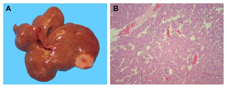 The development of HCC in rats exposed to DENA+RS and killed after one year. Panel A: macroscopic appearance, with withish-grey lesions displaying prominent vasculature; panel B: trabecular HCC with discrete cellular pleomorphism (100x).