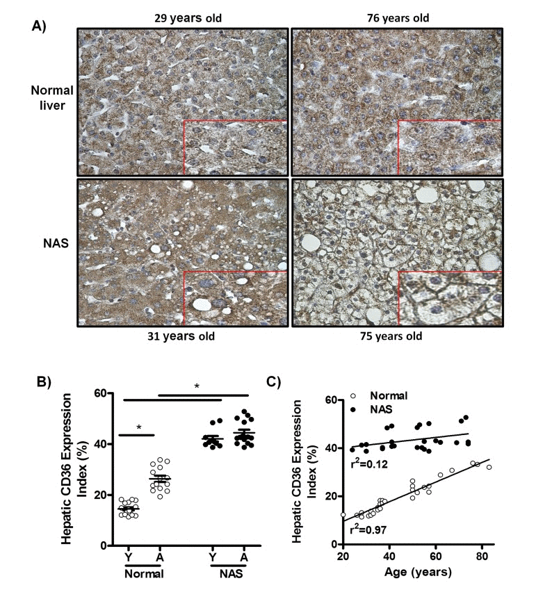 CD36 expression is positively associated with age in liver biopsies from patients with normal livers, but not in liver biopsies from patients with non-alcoholic steatosis (NAS)
