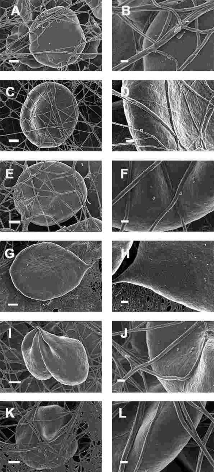 Whole blood of Parkinson's disease patients treated with desferal with added thrombin. All micrographs in left column are low magnifications while the micrographs in the right columns are the respective 100,000x machine magnification of the same individual's erythrocyte membranes. Serum ferritin levels: (A) and (B) 107 ng.mL−1 (C and D) 36 ng.mL-1 (E and F) 90 ng.mL−1 (G and H) 145 ng.mL−1 (I and J) 156 ng.mL−1 (K and L) 358 ng.mL−1 Low magnification scale bar = 1μm; high magnification scale bar is 200 nm.