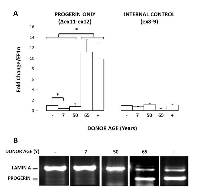 MIAMI cells can express endogenous progerin. (A) Endogenous progerin mRNA levels measured by qPCR in MIAMI cells collected from non-HGPS male donors of various ages (7-65 years). Progerin-transduced MIAMI cells collected from a 20-year-old donor (+) were used as a positive control. MIAMI cells collected from a 20 year old (−) were used as a negative control. (B) Using primer pairs to amplify both progerin and lamin A, qPCR results were run on an agarose gel to visualize amplification product length. Miami cells collected from a 65-year-old donor and progerin transduced MIAMI cells express both lamin A and progerin products. Values in Panel A are mean ± standard deviation (n≥3). *pt-test. P-values indicate significant difference between negative control, unless otherwise noted.