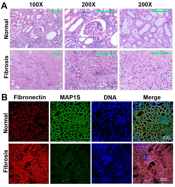 Levels of MAP1S are decreased and levels of fibronectin are elevated in renal tissues from patients suffering from renal fibrosis